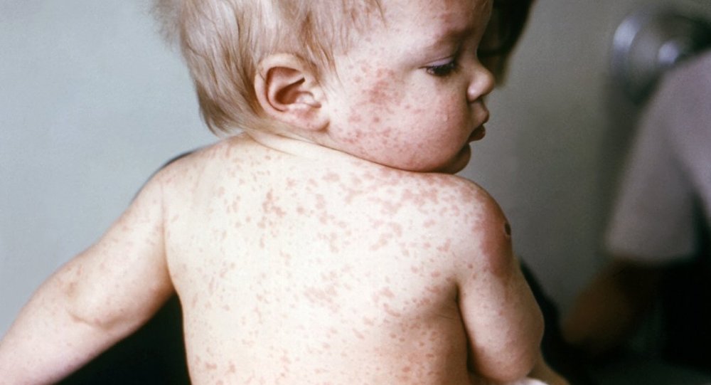 Qızılca epidemiyası elan edilə bilər - Nazirlik açıqladı