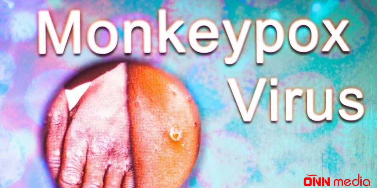 Meymunçiçəyinə yoluxanlara 21 günlük MƏHDUDİYYƏT