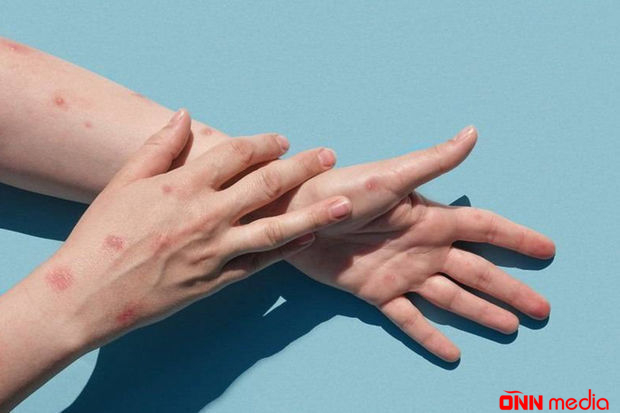 Meymunçiçəyinin yeni fəsadları açıqlandı