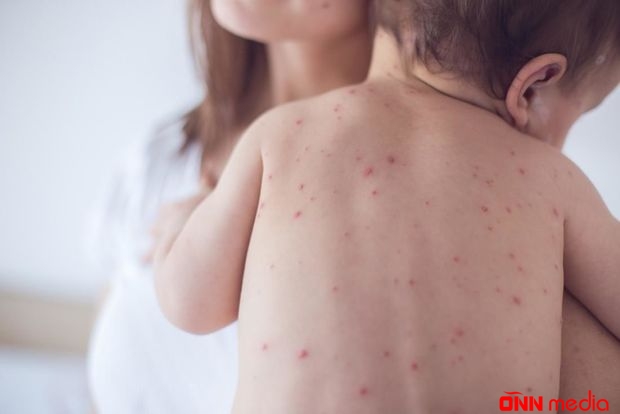 Qızılcaya yoluxanlara antibiotik vurmaq olmaz - RƏSMİ
